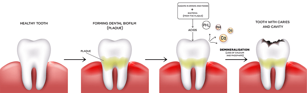 Durch Zahnbelag entstehen Bakterien die den Zahnschmelz angreifen - die Folge ist Karies und eine Schädigung der Zähne.