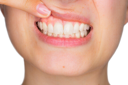Durch die richtige Mundhygiene erhält man gesundes Zahnfleisch und gesunde Zähne.